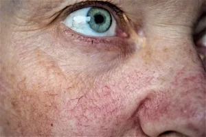 Facial Veins